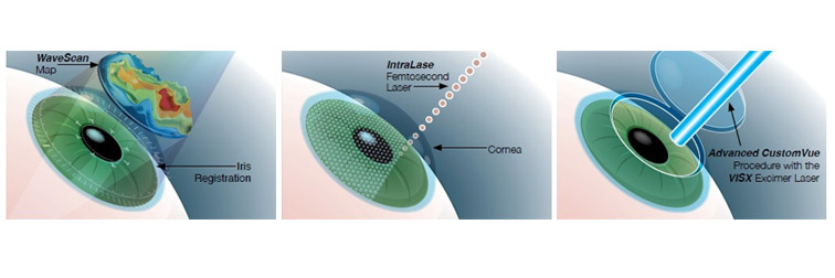 FEMTOSECOND LASIK ή BLADE FREE LASIK ΔΙΟΡΘΩΣΗ ΜΥΩΠΙΑΣ ΜΕ ΛΕΙΖΕΡ ΜΕΘΟΔΟΣ FEMTOSECOND