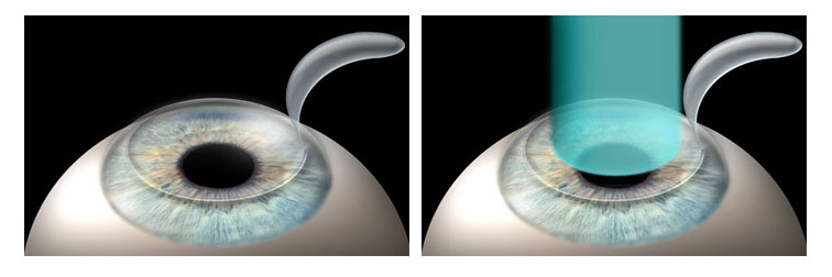 LASIK LASIK διόρθωση μυωπίας