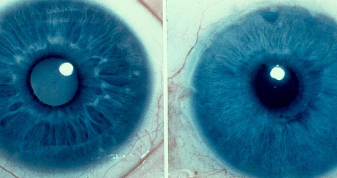 Καταρράκτης Πριν Μετά