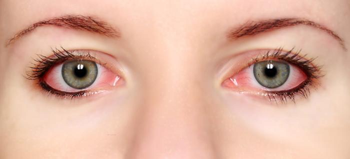 Επιπεφυκίτιδα