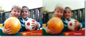 Ανησυχητικά συμπτώματα για καταρράκτη καταρράκτης