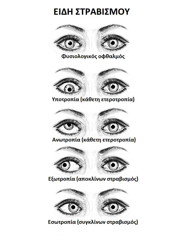 Στραβισμός Στραβισμός